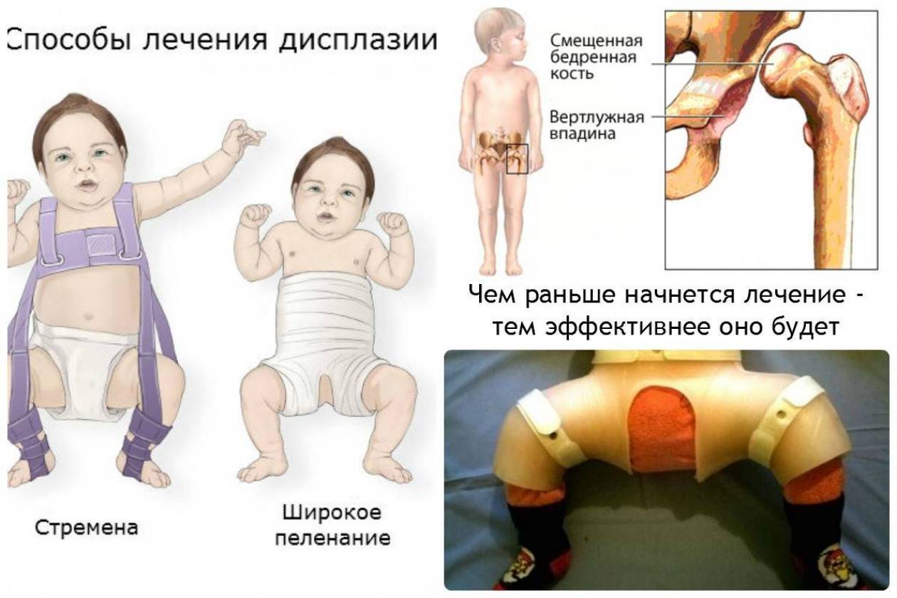 Передний вывих плеча — Упражнения