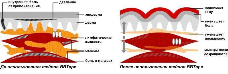 Что такое кинезио тейп, для чего используют кинезиологические пластыри